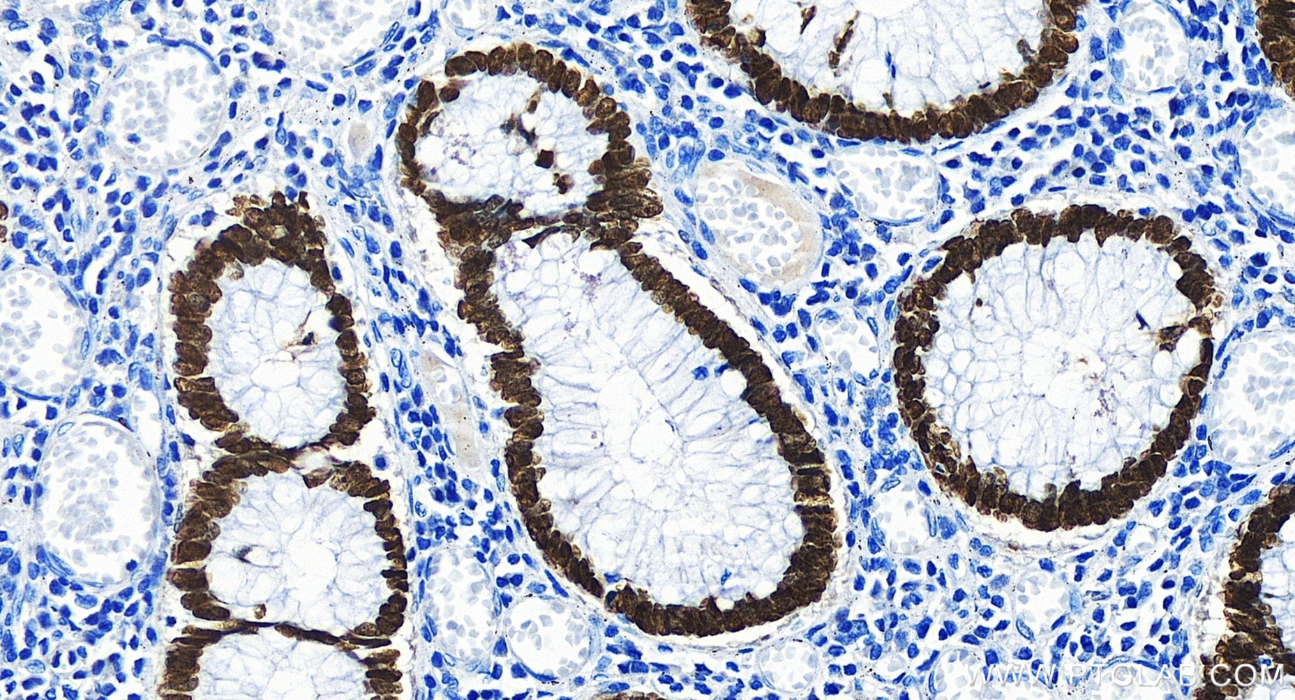 Immunohistochemistry (IHC) staining of human colon cancer tissue using SATB2 Recombinant antibody (85922-1-RR)