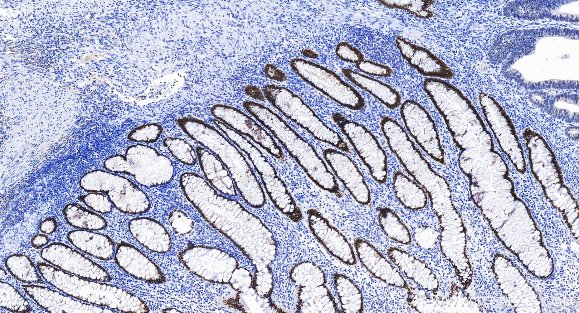 Immunohistochemistry (IHC) staining of human colon cancer tissue using SATB2 Recombinant antibody (85922-1-RR)