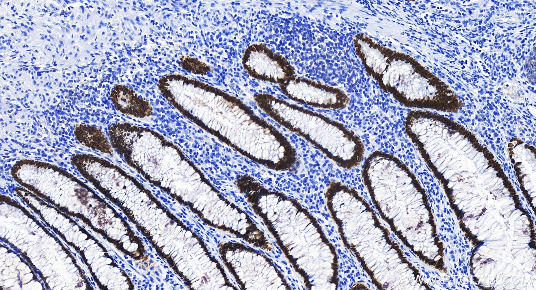 Immunohistochemistry (IHC) staining of human colon cancer tissue using SATB2 Recombinant antibody (85922-1-RR)