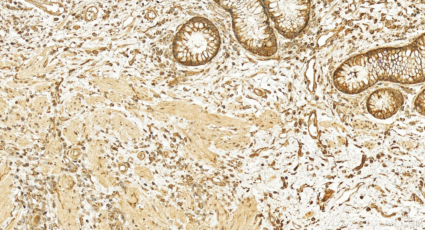 Immunohistochemistry (IHC) staining of human colon cancer tissue using SCFD2 Polyclonal antibody (13375-1-AP)