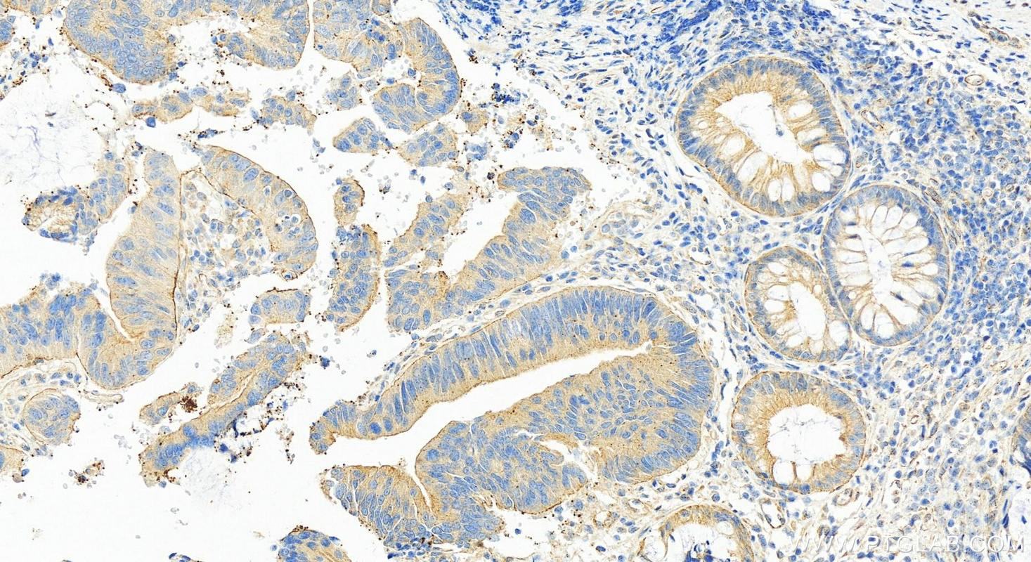 Immunohistochemistry (IHC) staining of human colon cancer tissue using SCLT1 Polyclonal antibody (14875-1-AP)