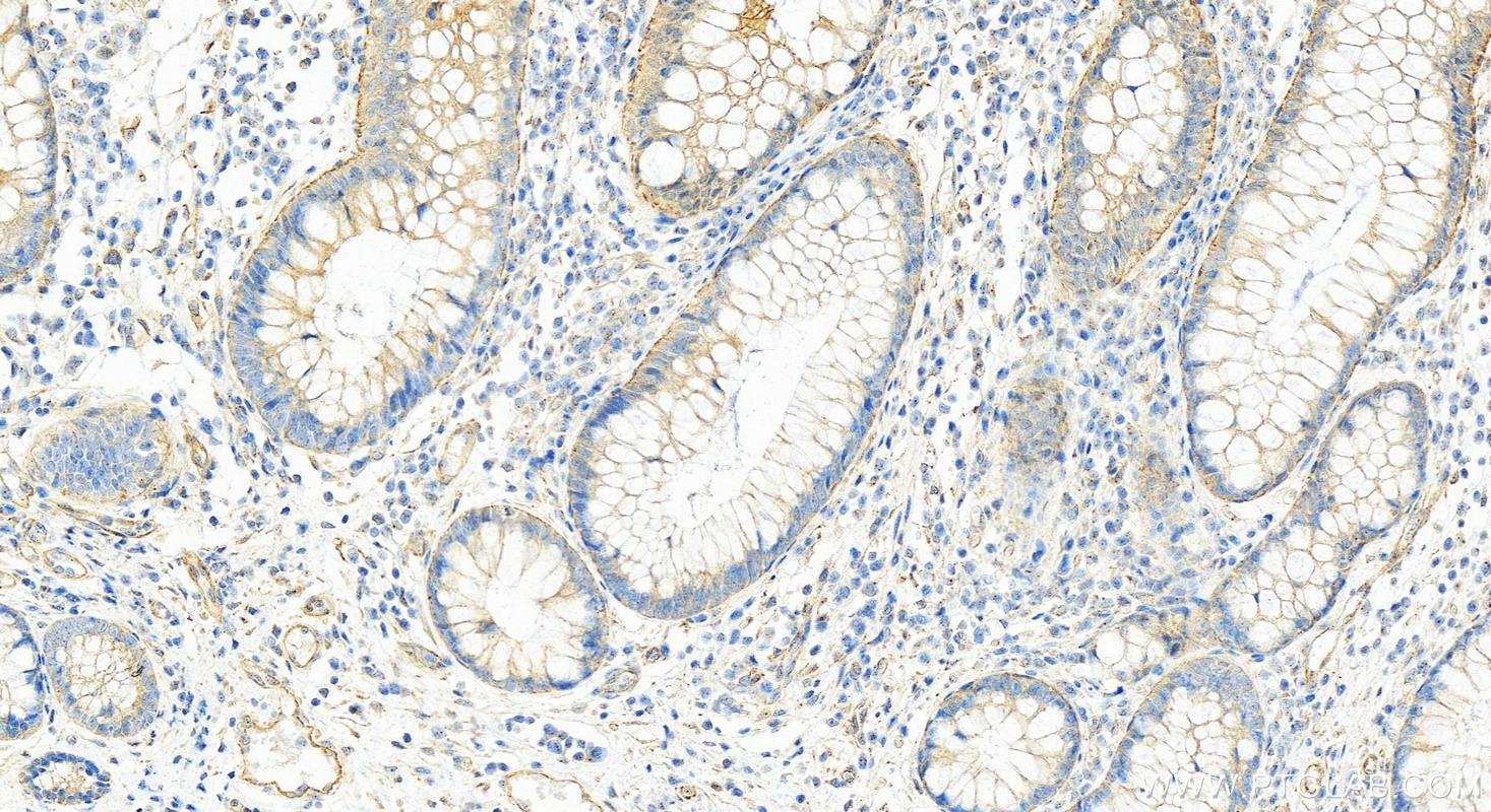 Immunohistochemistry (IHC) staining of human colon cancer tissue using SCLT1 Polyclonal antibody (14875-1-AP)