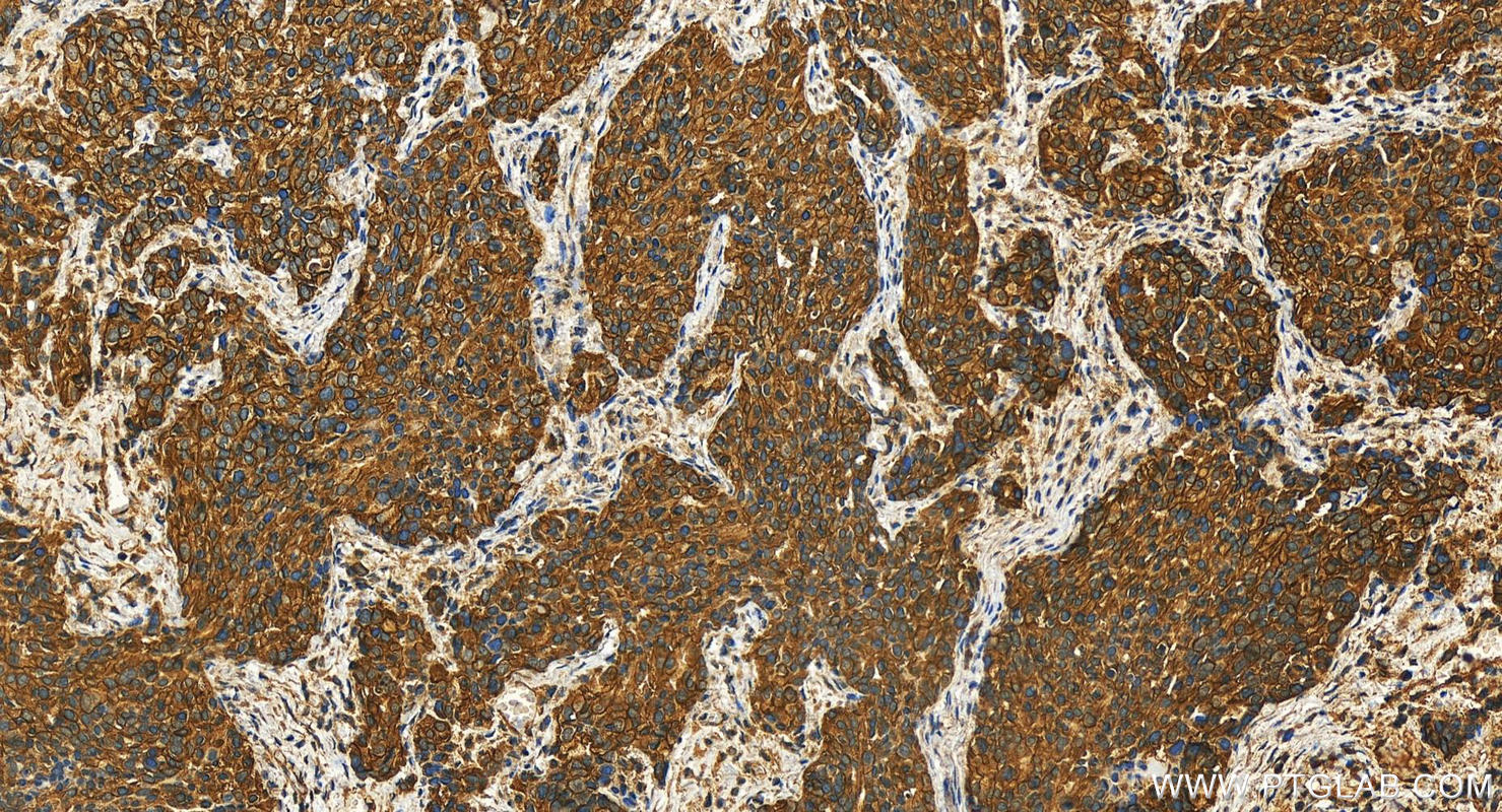 Immunohistochemistry (IHC) staining of human ovary cancer tissue using SCRIB Polyclonal antibody (27083-1-AP)