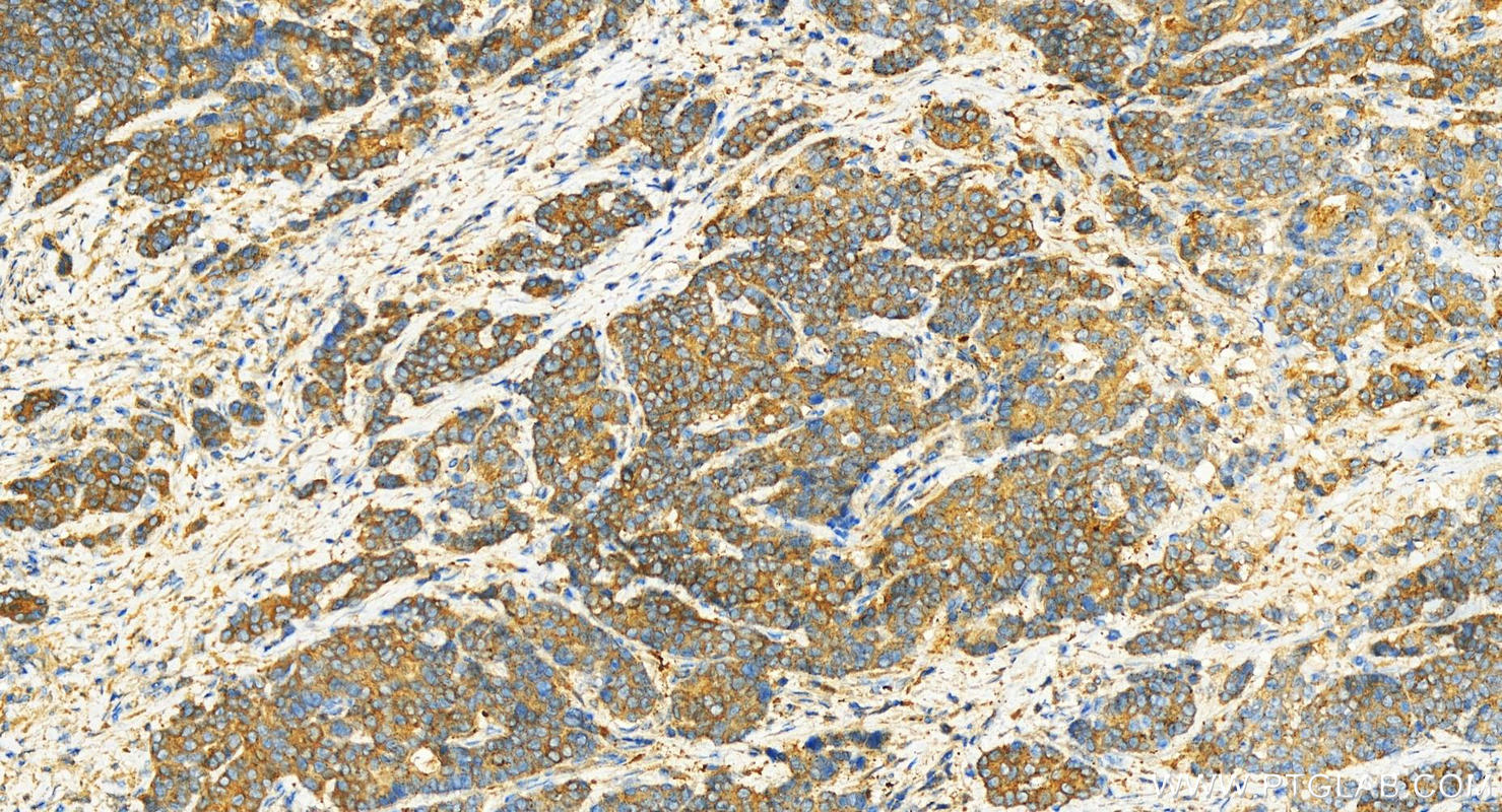 Immunohistochemistry (IHC) staining of human stomach cancer tissue using SCRN1 Polyclonal antibody (14303-1-AP)