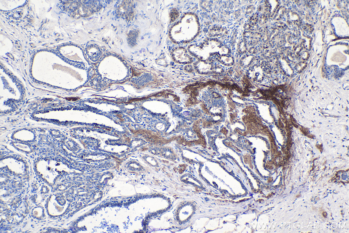 Immunohistochemistry (IHC) staining of human breast cancer tissue using Syntenin 2 Polyclonal antibody (10407-1-AP)