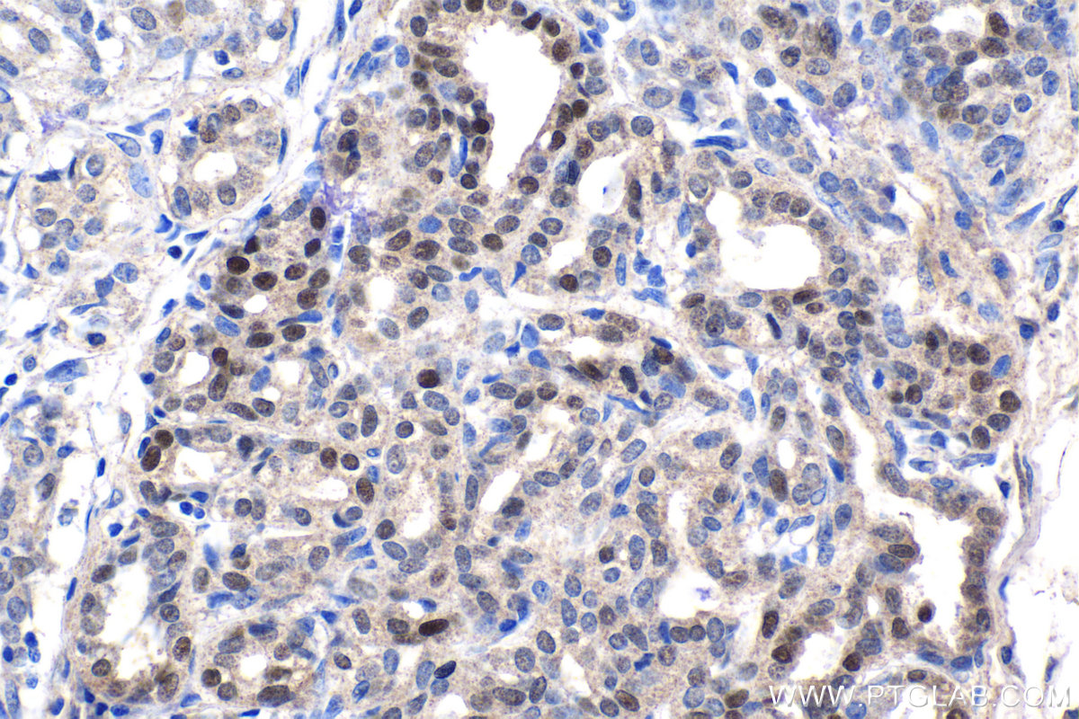 Immunohistochemistry (IHC) staining of human breast cancer tissue using Syntenin 2 Polyclonal antibody (10407-1-AP)