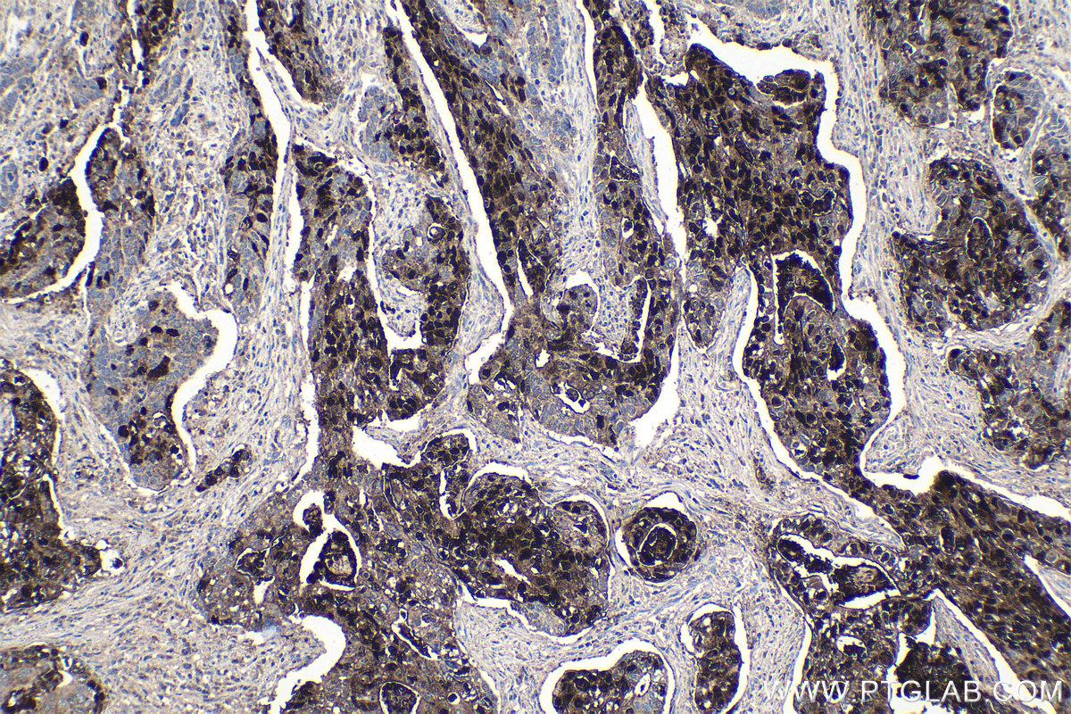 Immunohistochemistry (IHC) staining of human stomach cancer tissue using Syntenin 2 Polyclonal antibody (10407-1-AP)