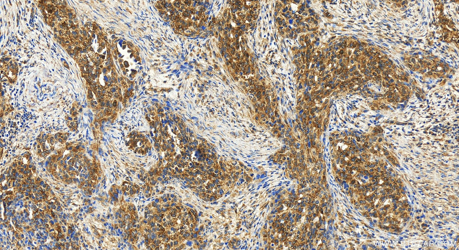 Immunohistochemistry (IHC) staining of human ovary cancer tissue using SDF2 Polyclonal antibody (14747-1-AP)