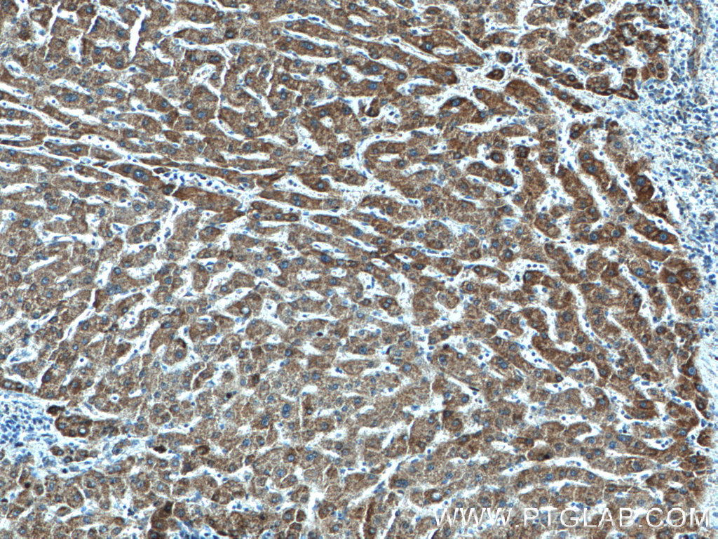 Immunohistochemistry (IHC) staining of human liver cancer tissue using SDHA Monoclonal antibody (66588-1-Ig)