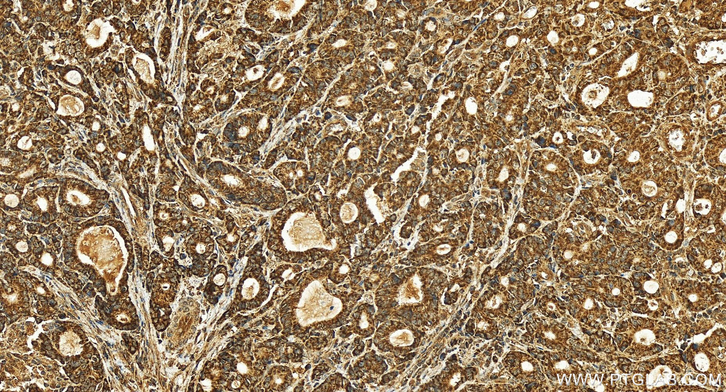 Immunohistochemistry (IHC) staining of human stomach cancer tissue using SDHD Polyclonal antibody (26519-1-AP)