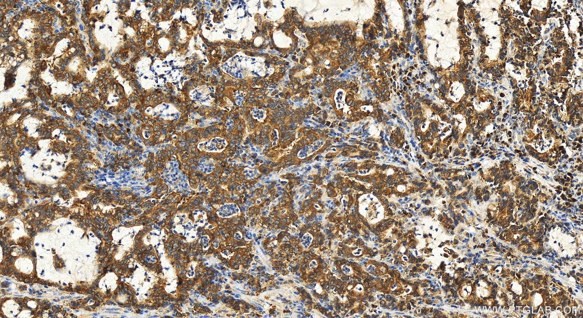 Immunohistochemistry (IHC) staining of human stomach cancer tissue using SEC23B Polyclonal antibody (30510-1-AP)