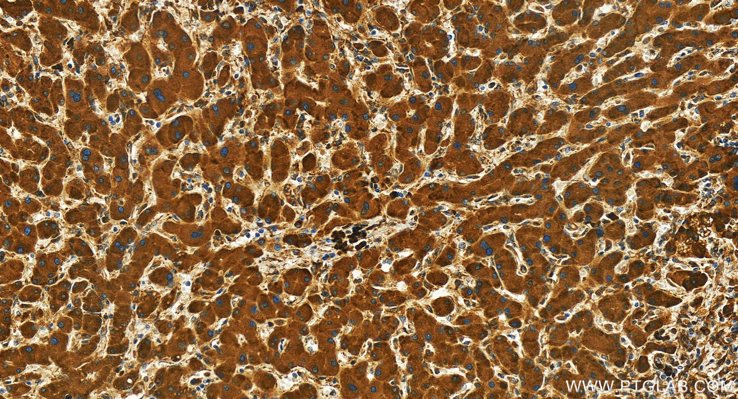 Immunohistochemistry (IHC) staining of human intrahepatic cholangiocarcinoma tissue using SEL1L Polyclonal antibody (29801-1-AP)