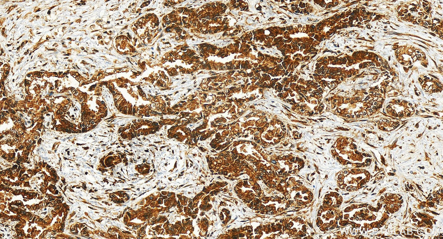 Immunohistochemistry (IHC) staining of human intrahepatic cholangiocarcinoma tissue using SEL1L Polyclonal antibody (29801-1-AP)