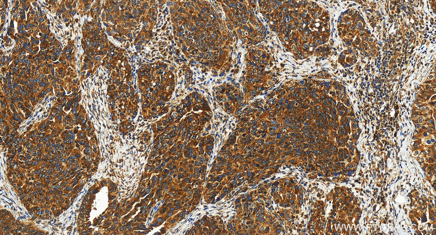 Immunohistochemistry (IHC) staining of human ovary cancer tissue using SEL1L Polyclonal antibody (29801-1-AP)