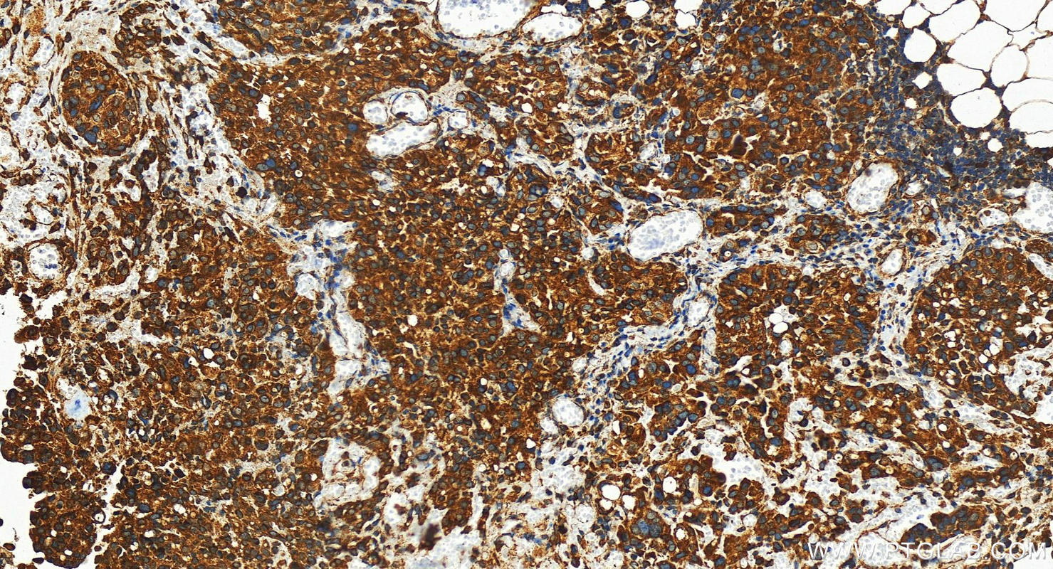 Immunohistochemistry (IHC) staining of human ovary cancer tissue using SEL1L Polyclonal antibody (29801-1-AP)