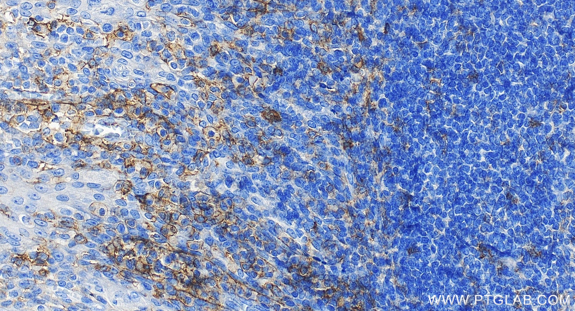 Immunohistochemistry (IHC) staining of human tonsillitis tissue using SELPLG/CD162 Recombinant monoclonal antibody (84500-1-RR)