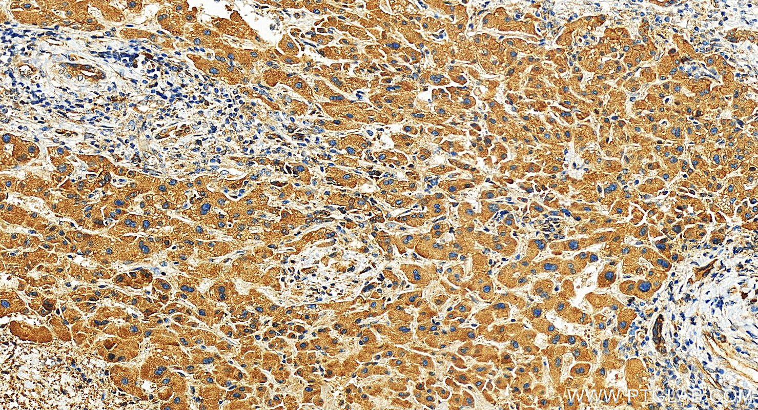 Immunohistochemistry (IHC) staining of human intrahepatic cholangiocarcinoma tissue using SELS Polyclonal antibody (15591-1-AP)