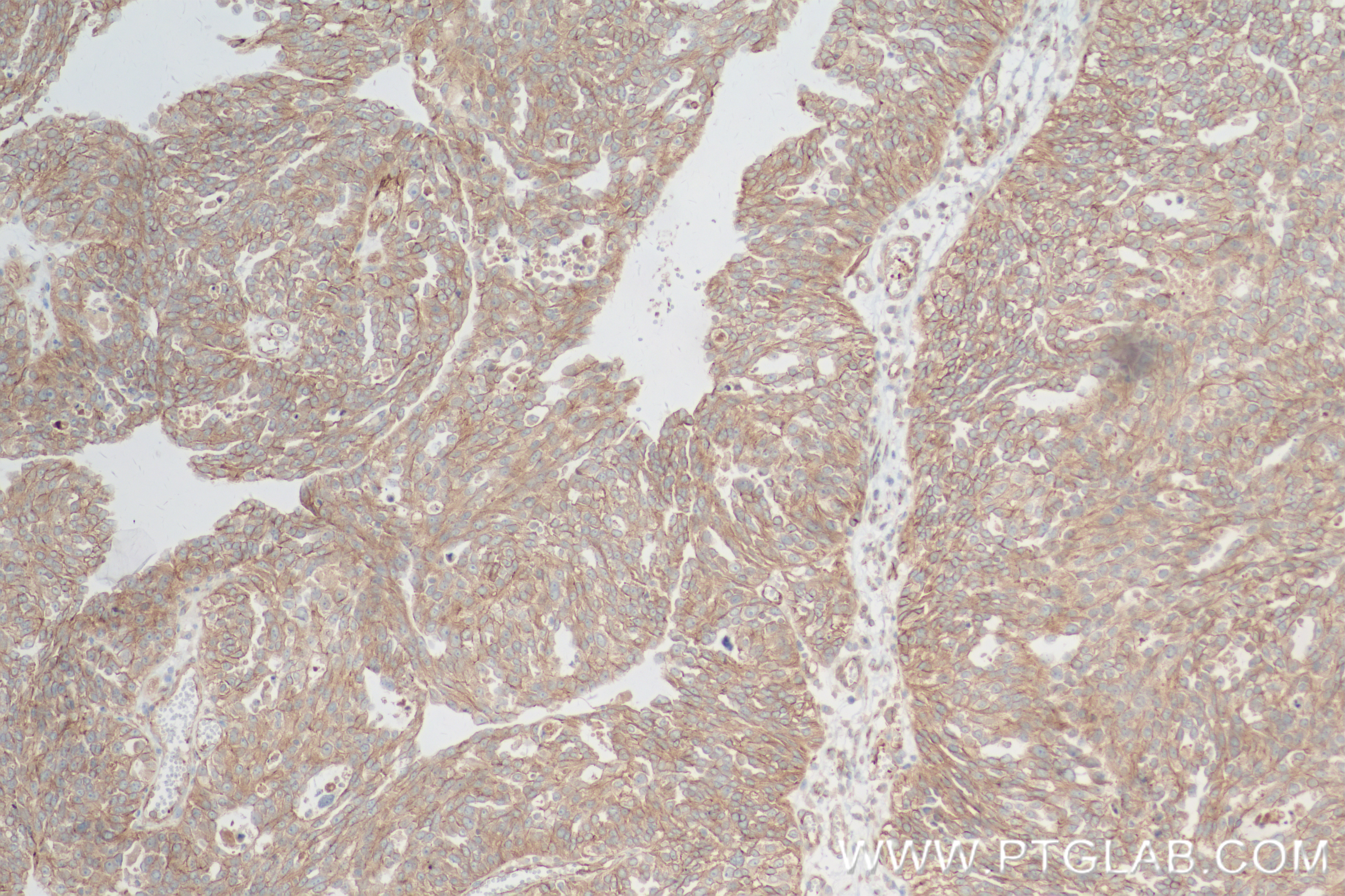 Immunohistochemistry (IHC) staining of human ovary cancer tissue using SEMA3A Recombinant antibody (83579-5-RR)