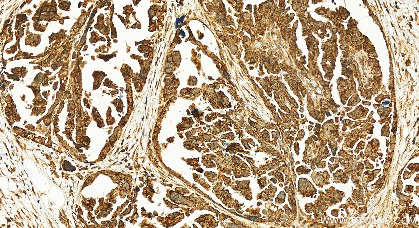 Immunohistochemistry (IHC) staining of human ovary cancer tissue using SENP1 Polyclonal antibody (25349-1-AP)