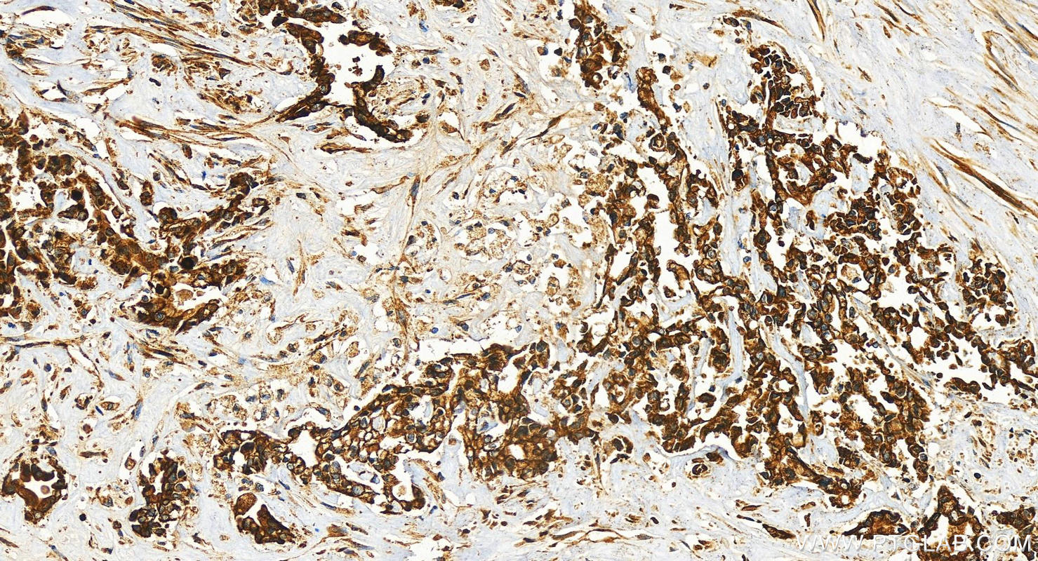 Immunohistochemistry (IHC) staining of human intrahepatic cholangiocarcinoma tissue using SENP1 Recombinant antibody (83594-1-RR)