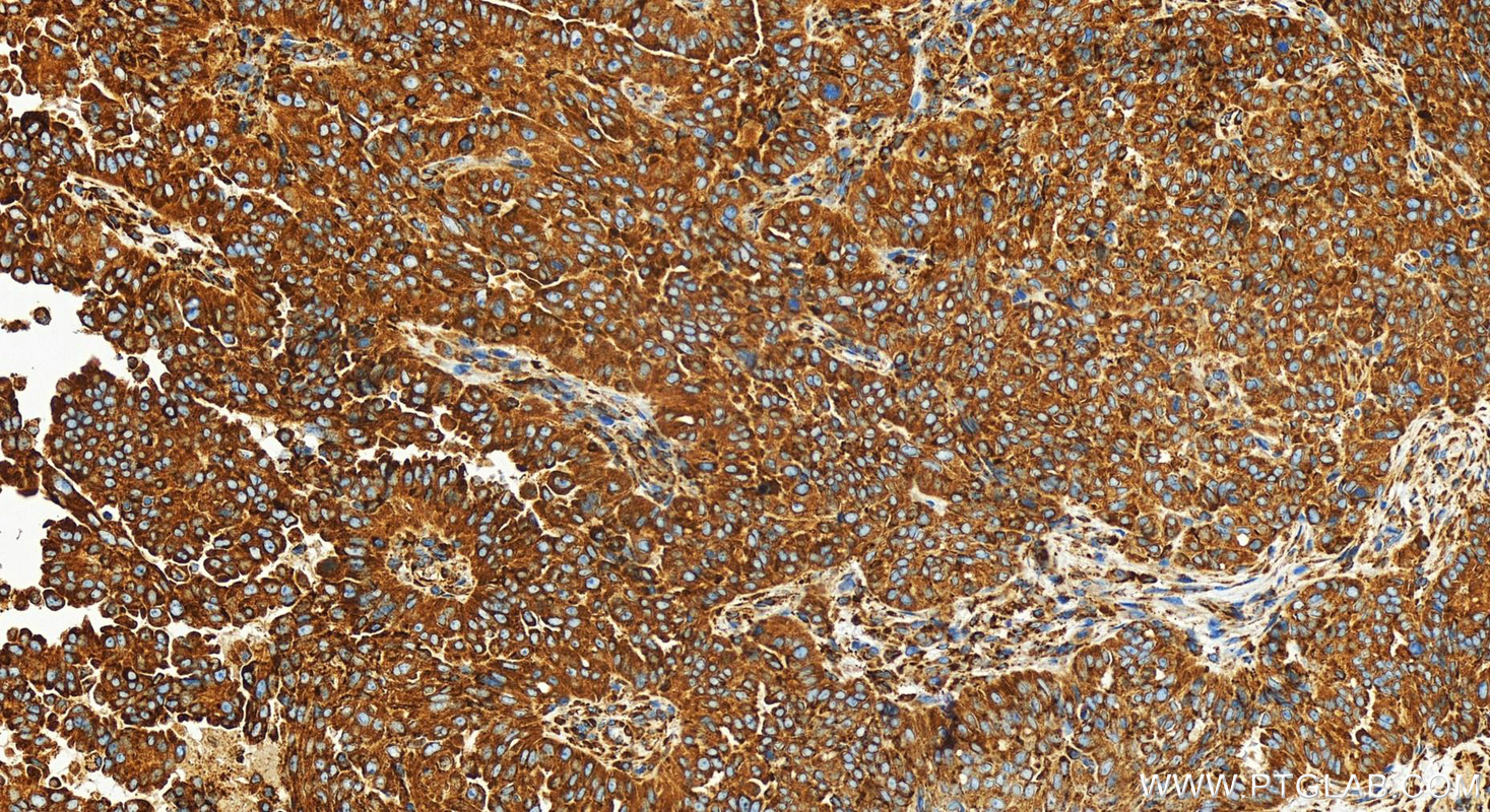 Immunohistochemistry (IHC) staining of human ovarian  cancer using SENP1 Recombinant antibody (83594-4-RR)