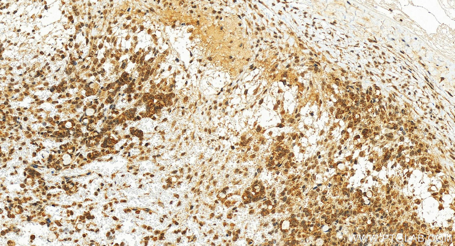 Immunohistochemistry (IHC) staining of human ovary cancer tissue using SENP3 Polyclonal antibody (17659-1-AP)