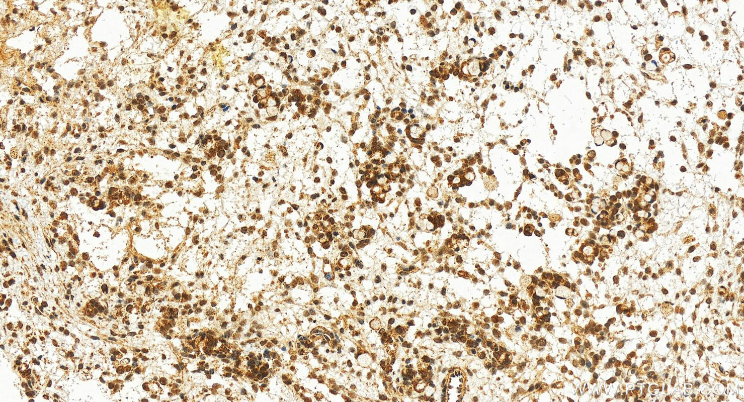 Immunohistochemistry (IHC) staining of human ovary cancer tissue using SENP3 Polyclonal antibody (17659-1-AP)