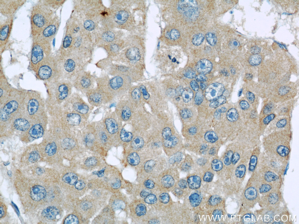 Immunohistochemistry (IHC) staining of human liver cancer tissue using Septin 2 Monoclonal antibody (60075-1-Ig)