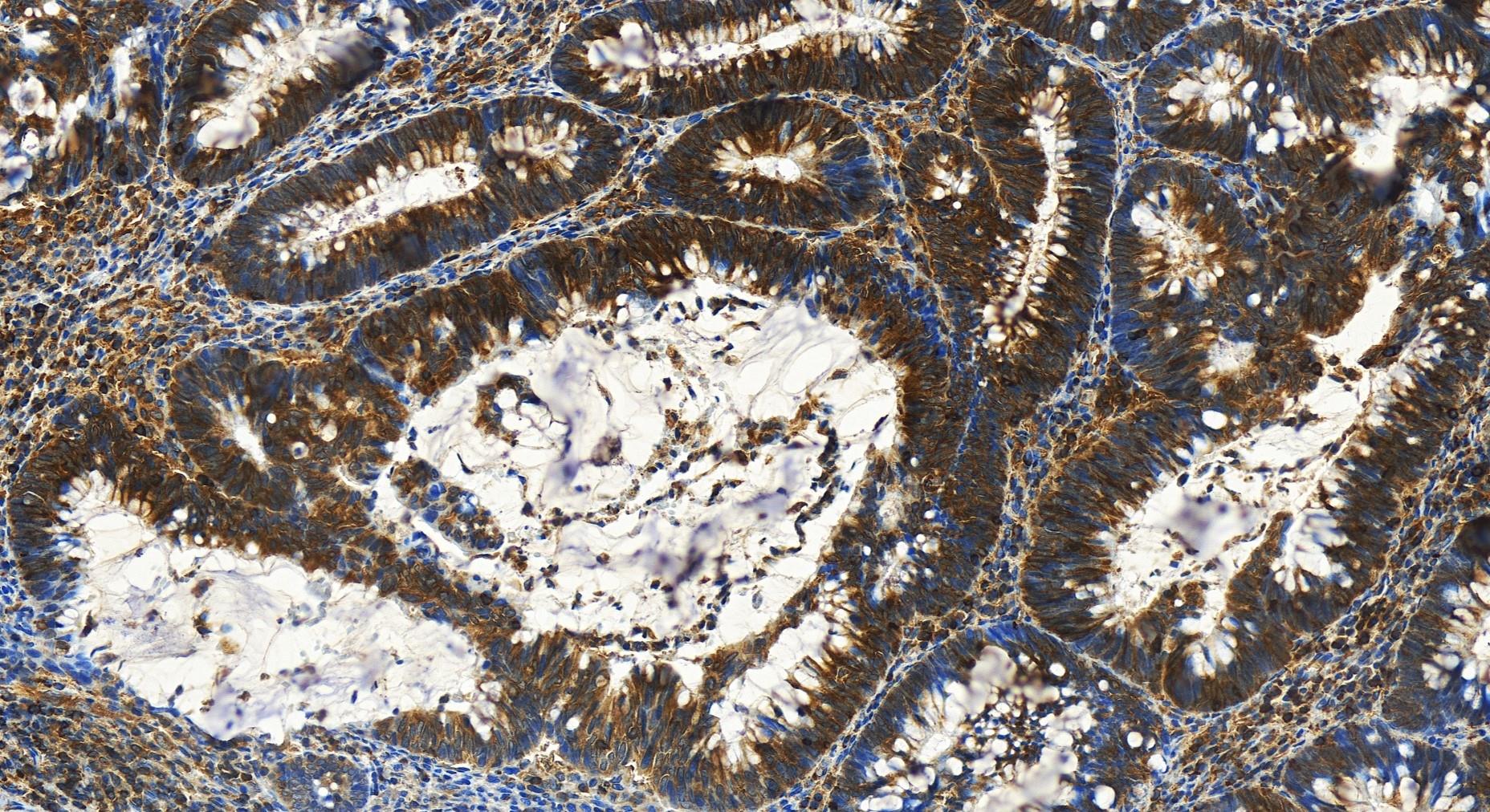 Immunohistochemistry (IHC) staining of human colon  cancer using SEPT9 Recombinant antibody (82844-2-RR)