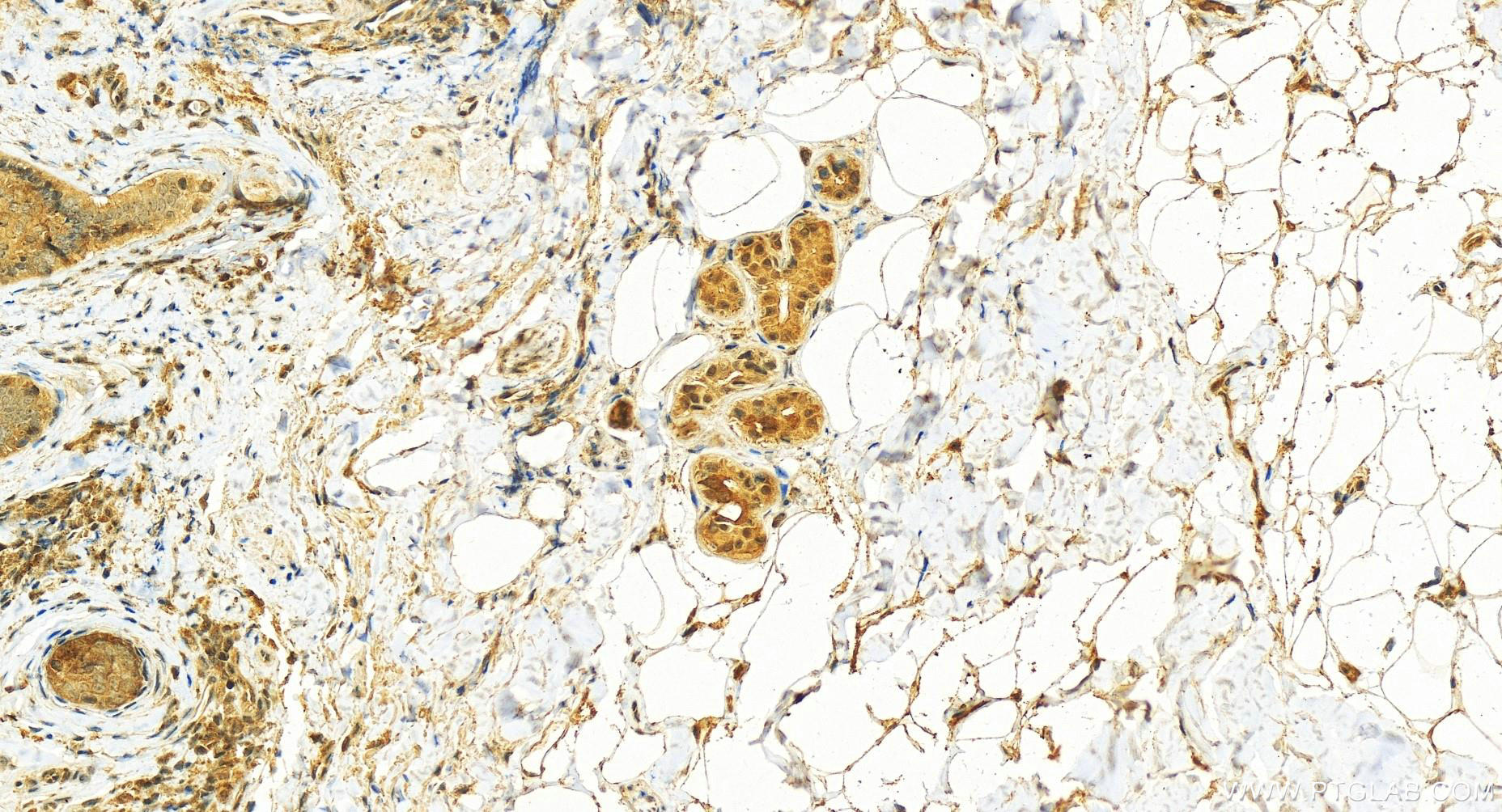 Immunohistochemistry (IHC) staining of human skin cancer tissue using SERF2 Polyclonal antibody (11691-1-AP)