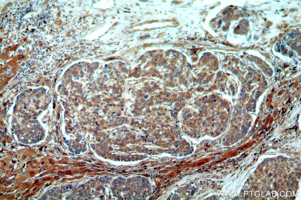 Immunohistochemistry (IHC) staining of human liver cancer tissue using SERINC1 Polyclonal antibody (20265-1-AP)