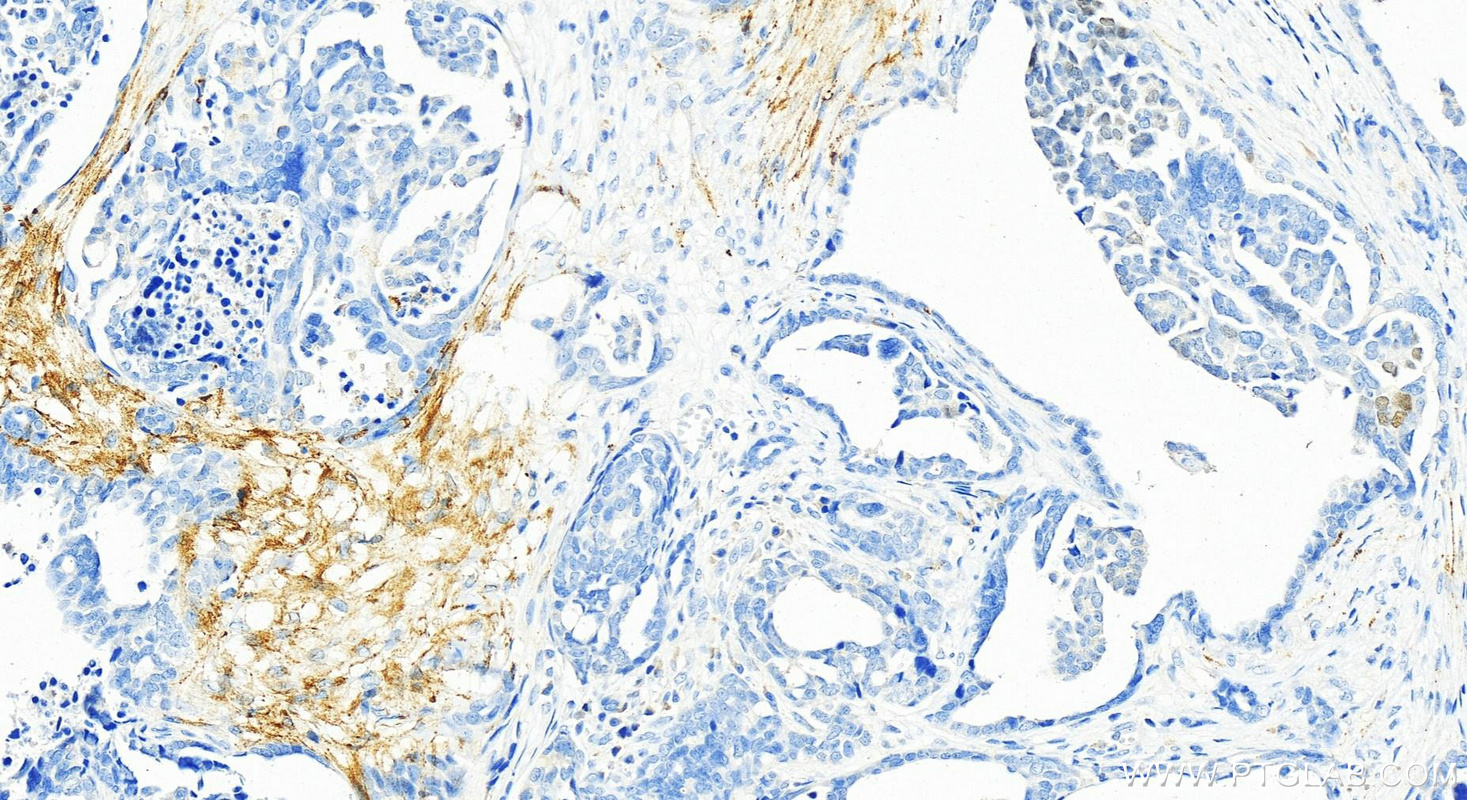 Immunohistochemistry (IHC) staining of human ovary cancer tissue using Protein C inhibitor Polyclonal antibody (10673-1-AP)