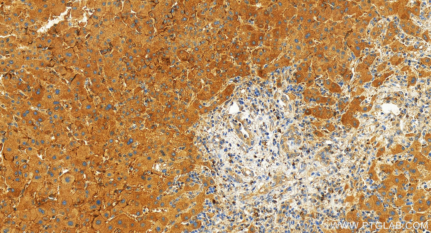 Immunohistochemistry (IHC) staining of human intrahepatic cholangiocarcinoma tissue using SERPINB3/4 Polyclonal antibody (26558-1-AP)