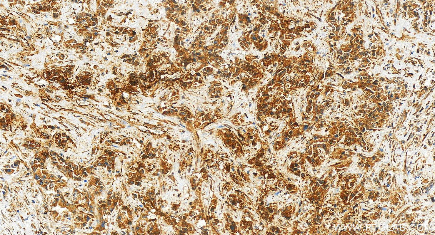 Immunohistochemistry (IHC) staining of human intrahepatic cholangiocarcinoma tissue using SERPINB3/4 Polyclonal antibody (26558-1-AP)