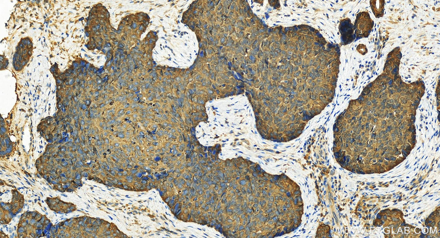 Immunohistochemistry (IHC) staining of human bowen disease using Maspin Polyclonal antibody (11722-1-AP)