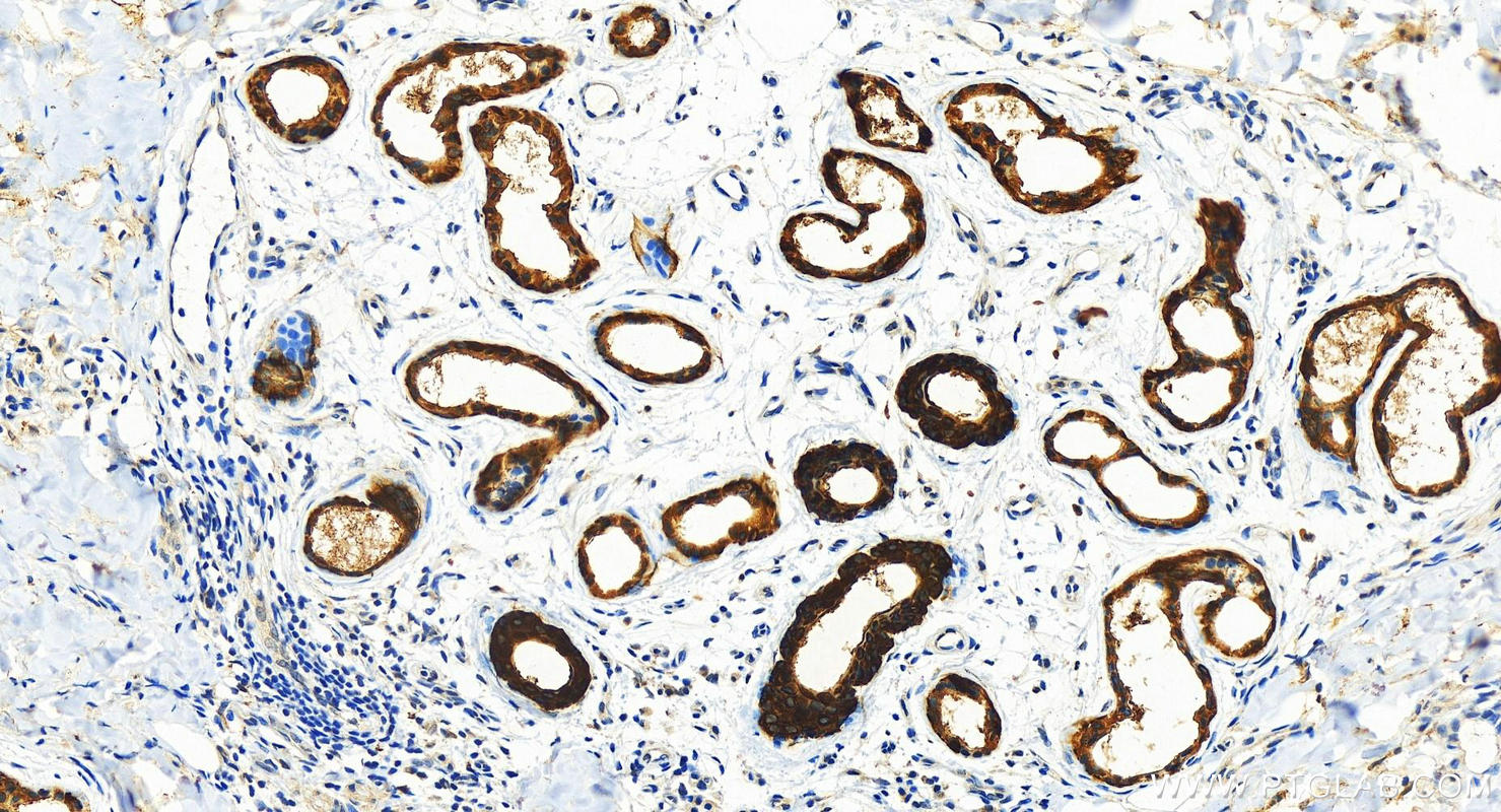 Immunohistochemistry (IHC) staining of human bowen disease using Maspin Polyclonal antibody (11722-1-AP)