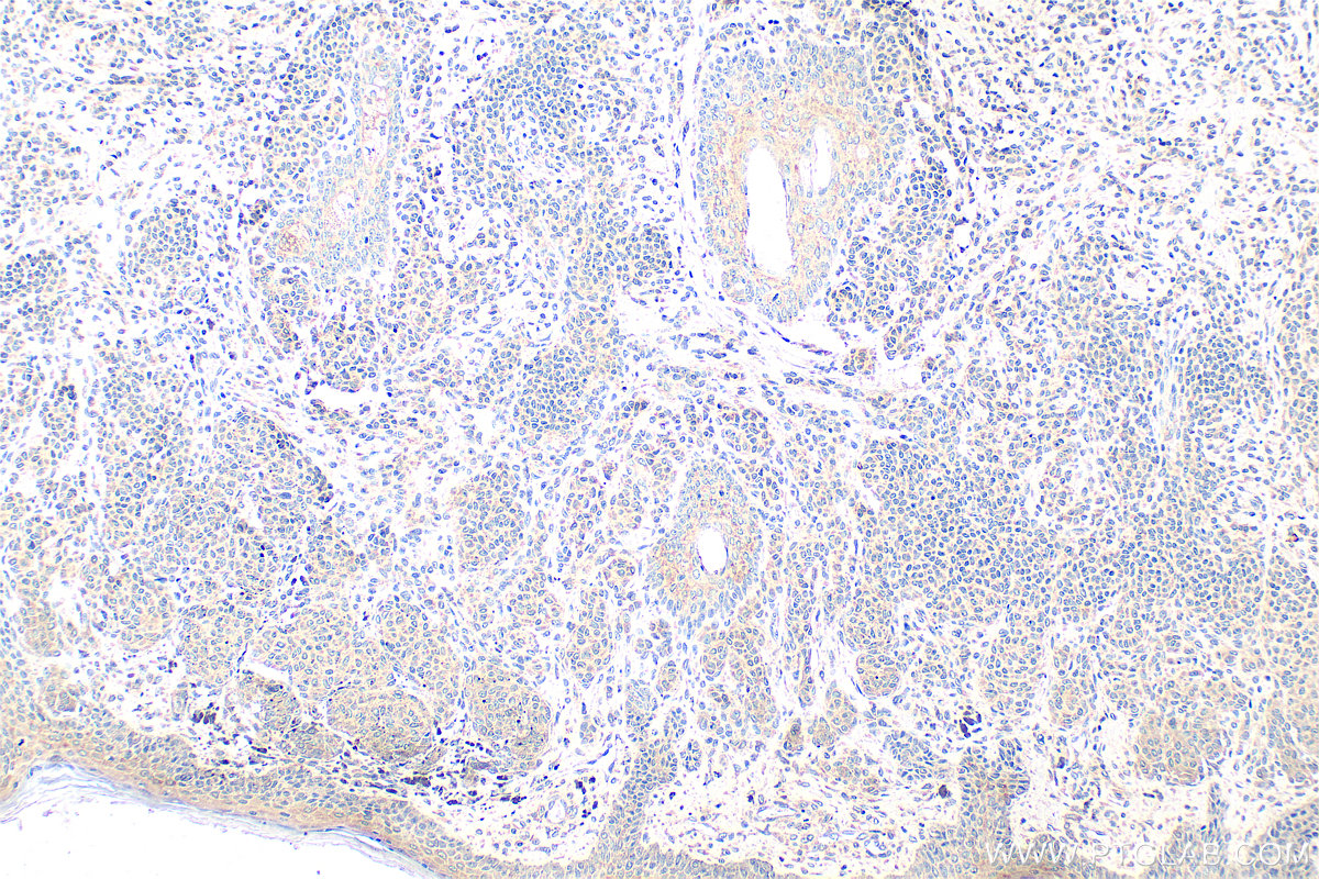 Immunohistochemistry (IHC) staining of human malignant melanoma tissue using Serpin E1/PAI-1 Polyclonal antibody (13801-1-AP)