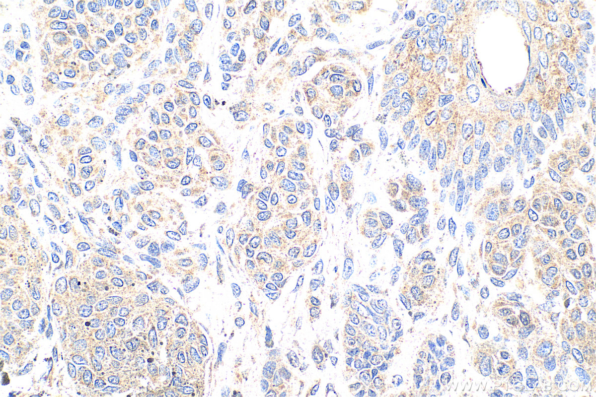 Immunohistochemistry (IHC) staining of human malignant melanoma tissue using Serpin E1/PAI-1 Polyclonal antibody (13801-1-AP)