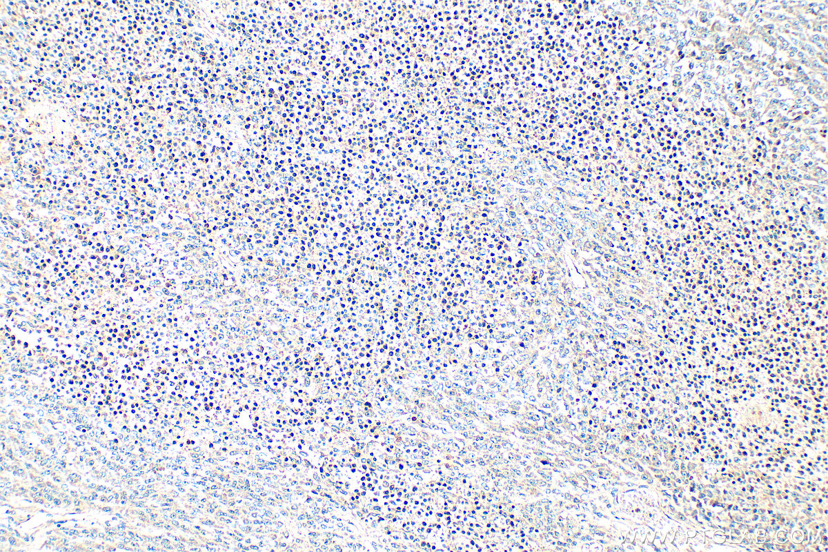 Immunohistochemistry (IHC) staining of human malignant melanoma tissue using Serpin E1/PAI-1 Polyclonal antibody (13801-1-AP)