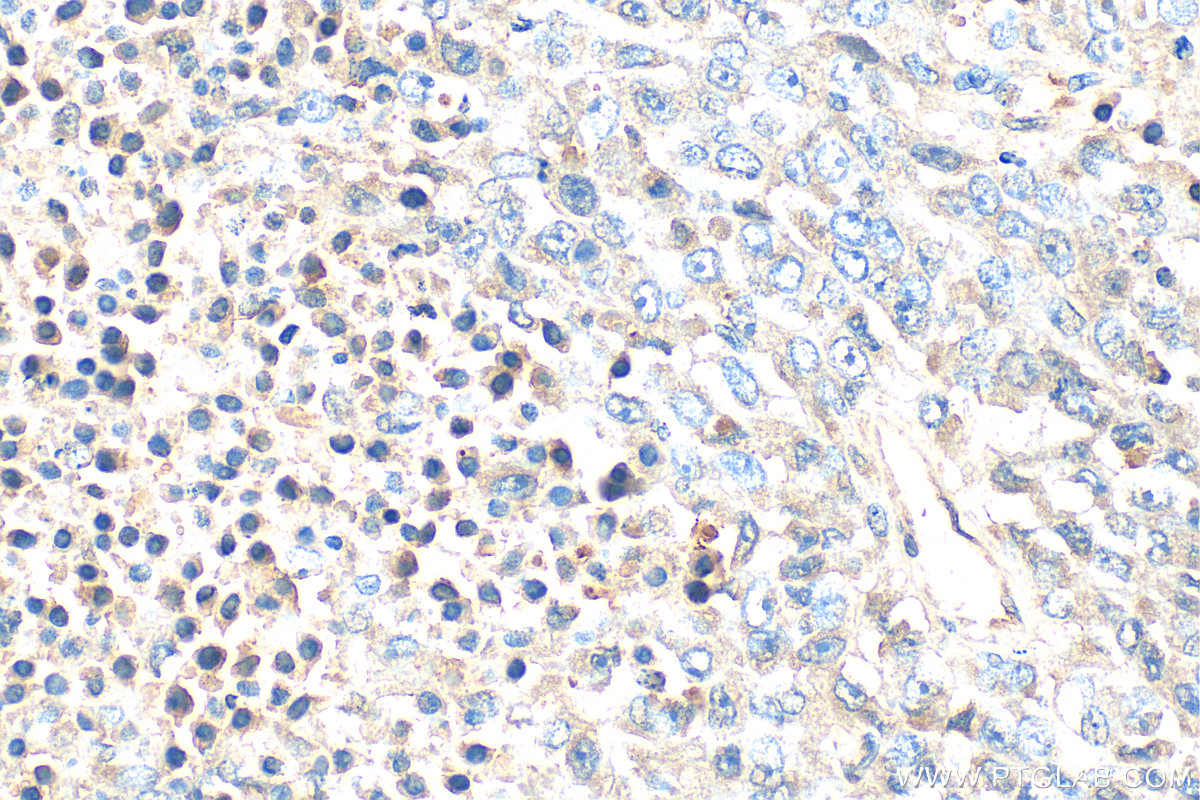 Immunohistochemistry (IHC) staining of human malignant melanoma tissue using Serpin E1/PAI-1 Polyclonal antibody (13801-1-AP)
