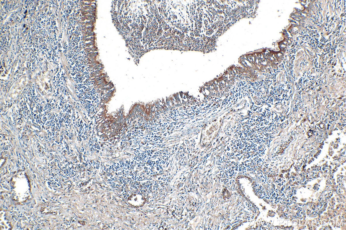 Immunohistochemistry (IHC) staining of human lung cancer tissue using Serpin E1/PAI-1 Polyclonal antibody (13801-1-AP)