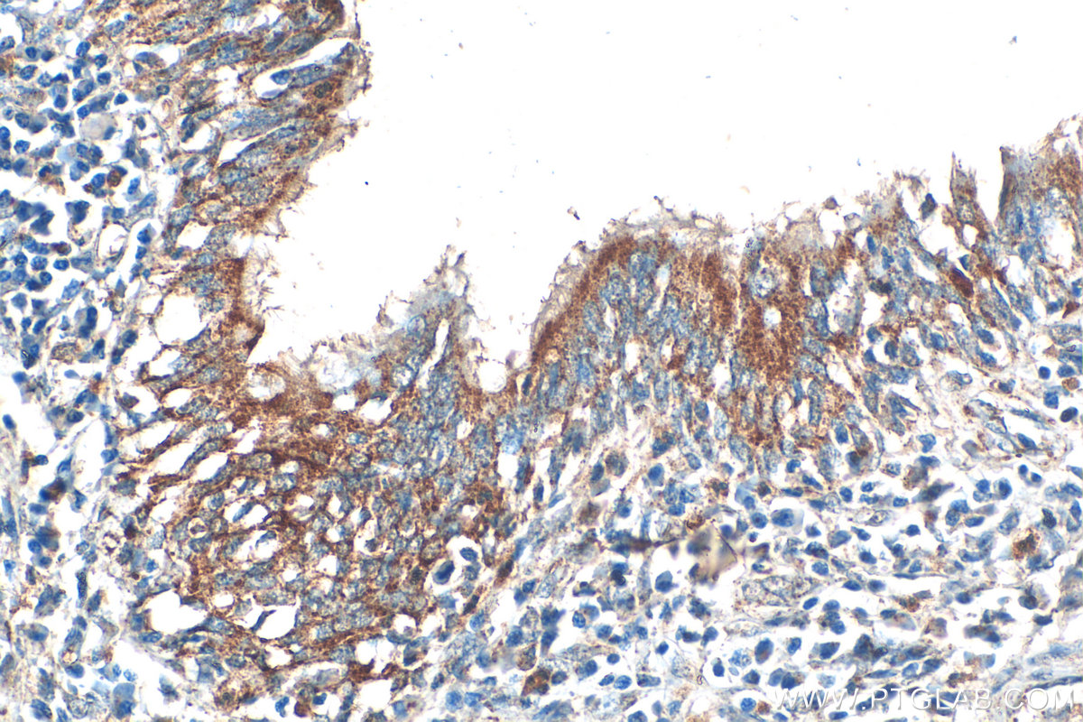 Immunohistochemistry (IHC) staining of human lung cancer tissue using Serpin E1/PAI-1 Polyclonal antibody (13801-1-AP)
