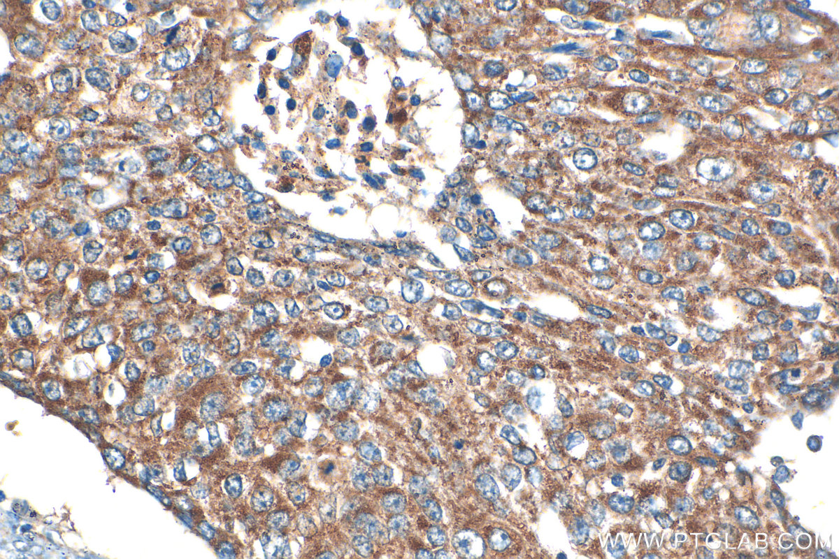 Immunohistochemistry (IHC) staining of human lung cancer tissue using Serpin E1/PAI-1 Polyclonal antibody (13801-1-AP)