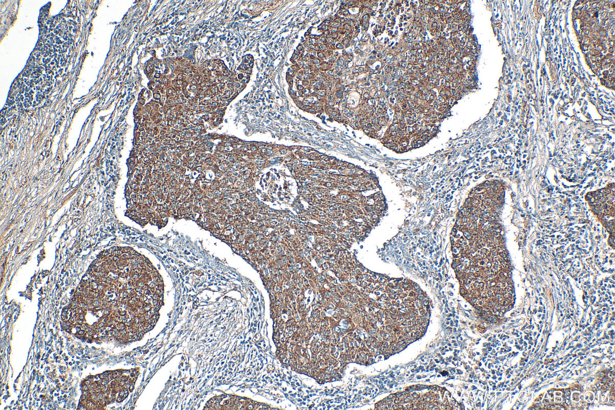 Immunohistochemistry (IHC) staining of human lung cancer tissue using Serpin E1/PAI-1 Polyclonal antibody (13801-1-AP)