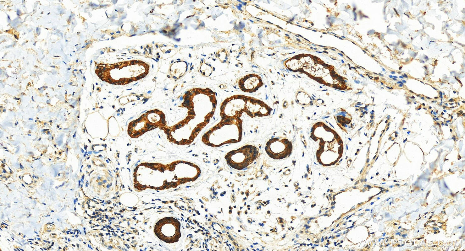 Immunohistochemistry (IHC) staining of human bowen disease using 14-3-3 Sigma Polyclonal antibody (10622-1-AP)