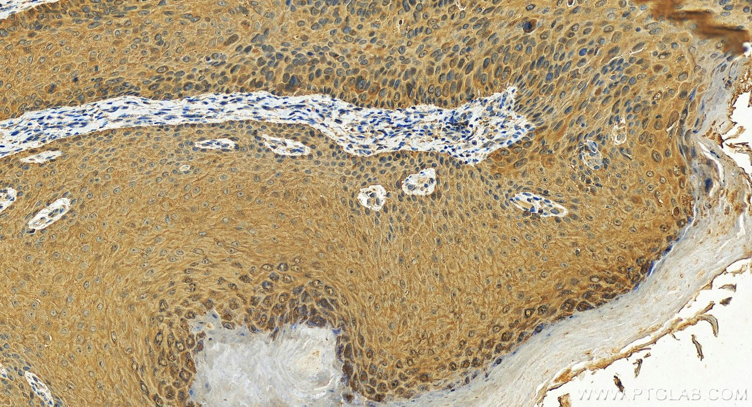 Immunohistochemistry (IHC) staining of human bowen disease using 14-3-3 Sigma Polyclonal antibody (10622-1-AP)