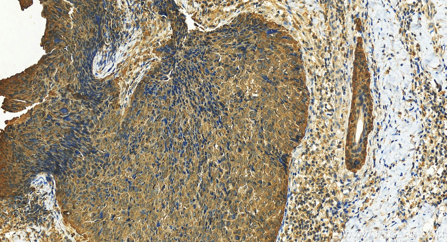 Immunohistochemistry (IHC) staining of human bowen disease using 14-3-3 Sigma Polyclonal antibody (10622-1-AP)