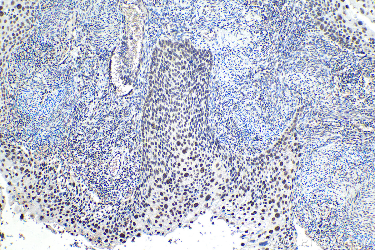 Immunohistochemistry (IHC) staining of human cervical cancer tissue using SFRS9 Polyclonal antibody (17926-1-AP)