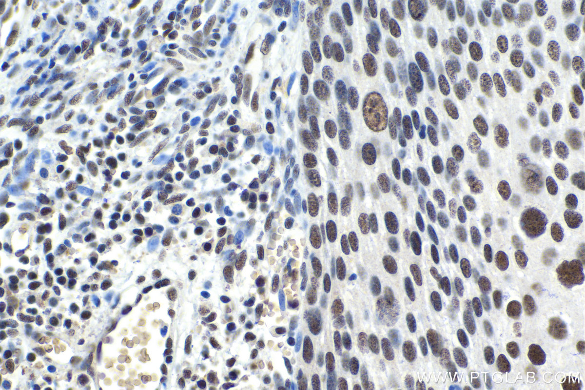 Immunohistochemistry (IHC) staining of human cervical cancer tissue using SFRS9 Polyclonal antibody (17926-1-AP)