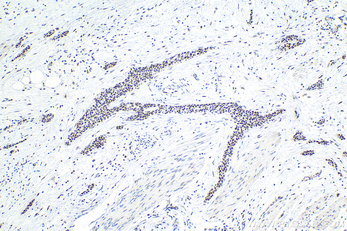 Immunohistochemistry (IHC) staining of human urothelial carcinoma tissue using SFRS9 Polyclonal antibody (17926-1-AP)